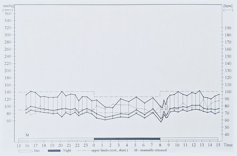 24-hour ambulatory blood pressure monitoring (24-hr ABPM ). (A) 24