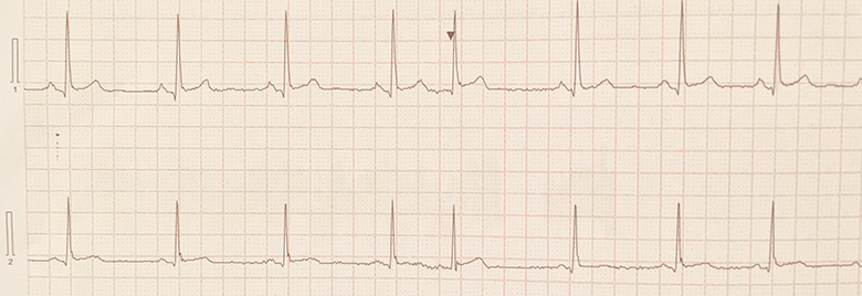 Holter ECG monitor