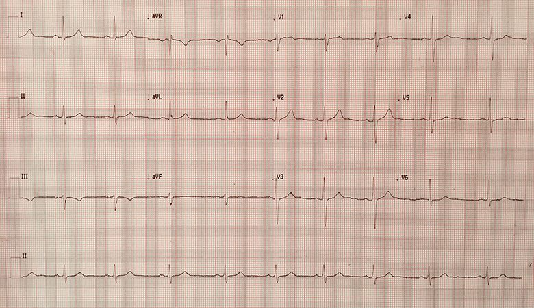 Electrocardiogram (ECG)