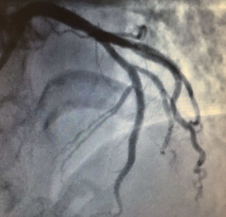 Coronary angiography