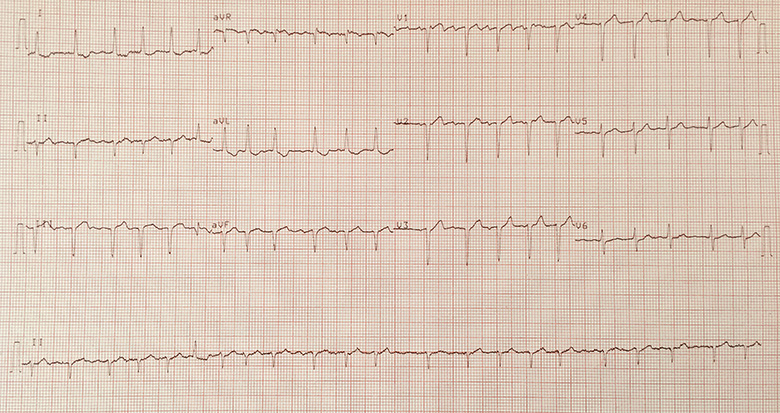 Arrhythmia