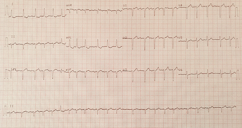 Arrhythmia