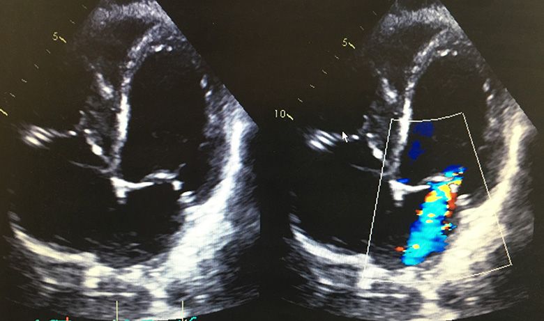 Echocardiogram