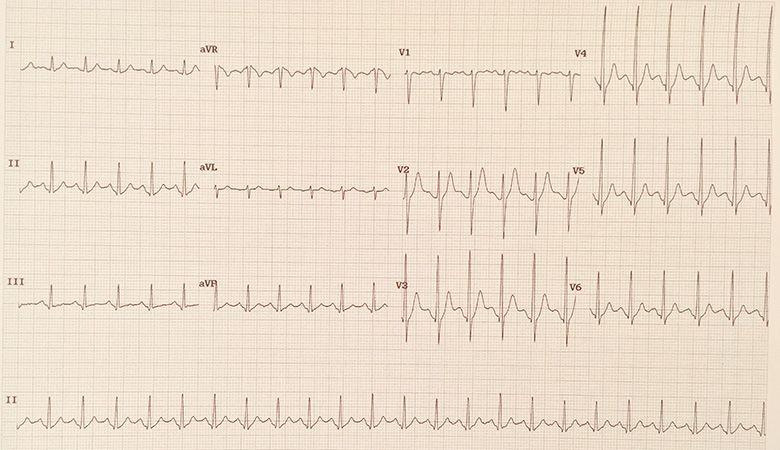 Exercise tolerance test (ETT)