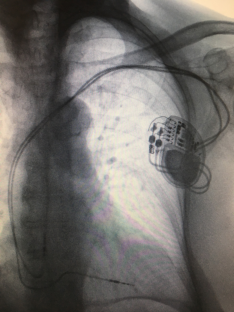 Permanent Pacemaker (PPM)